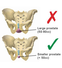 Illustration showing how the pelvic bone can shield parts of larger prostate glands