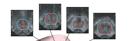 Transrectal ultrasound showing a series of prostate ultrasound images used to construct a 3-dimesnsional image of the prostate (volume study) and treatment plan.